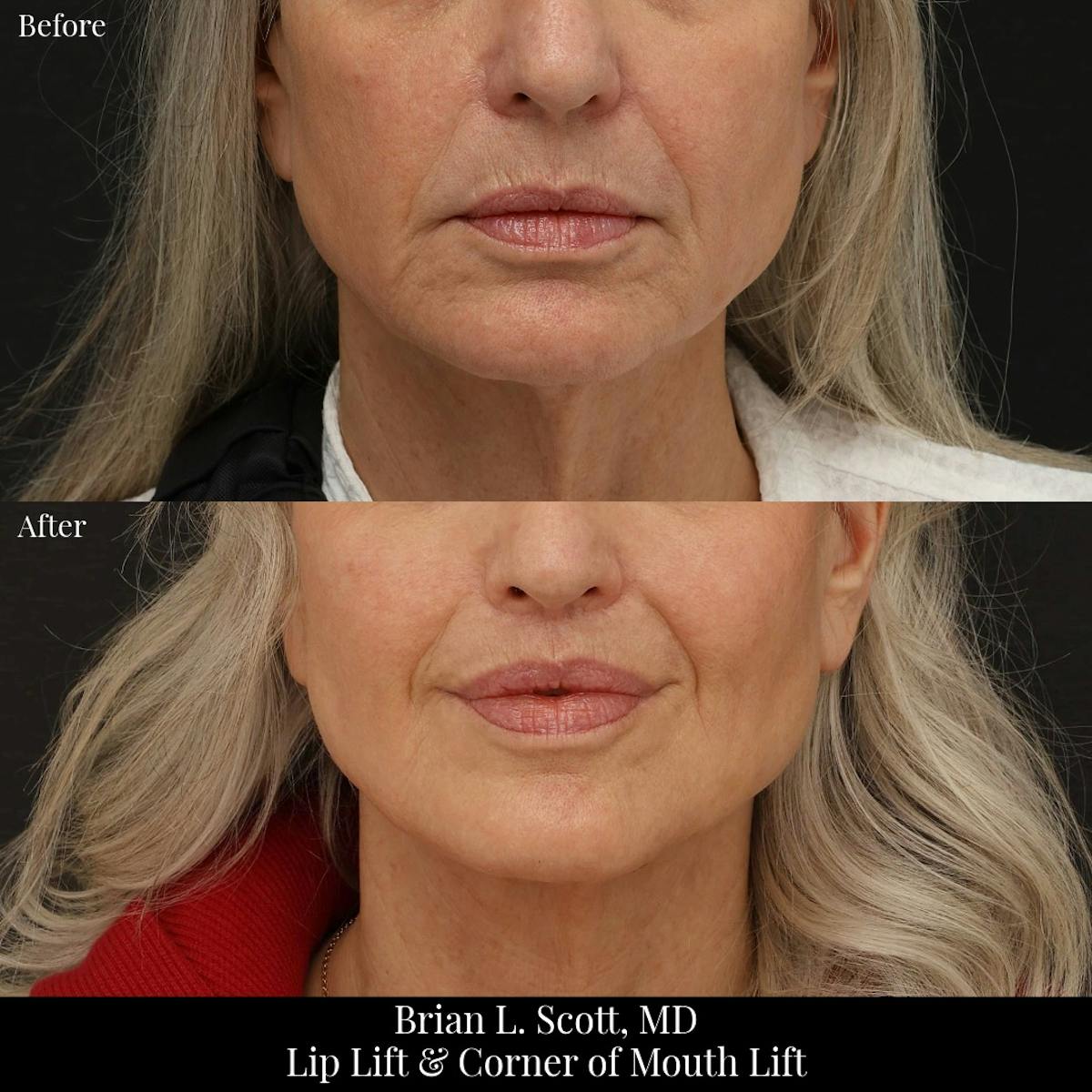 Lip Lift Before & After Gallery - Patient 371395 - Image 1
