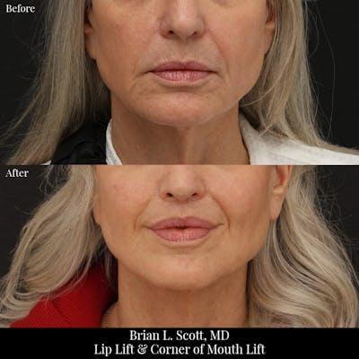 Lip Lift Before & After Gallery - Patient 371395 - Image 1