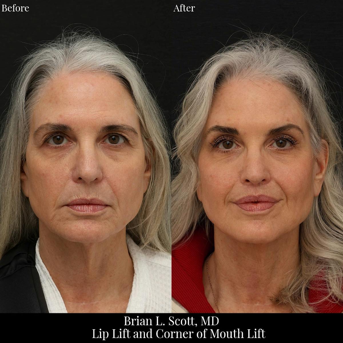 Lip Lift Before & After Gallery - Patient 371395 - Image 4