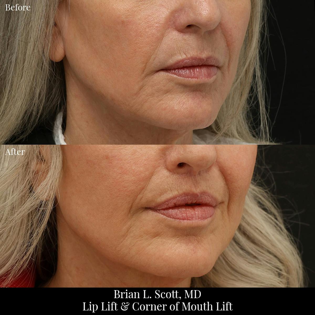 Lip Lift Before & After Gallery - Patient 371395 - Image 3