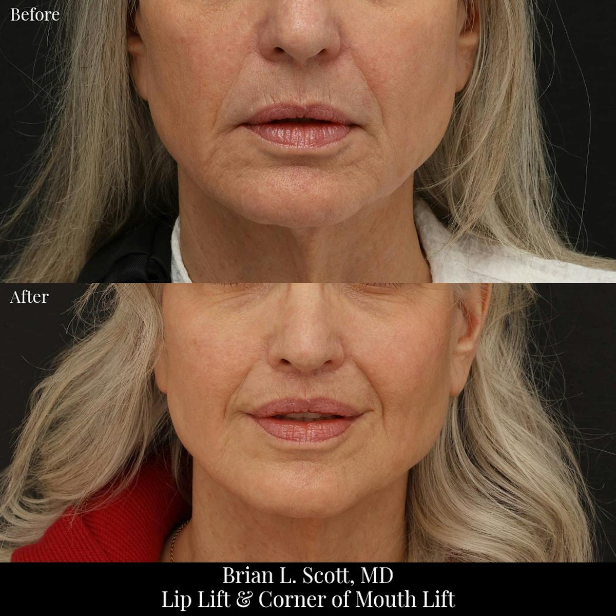 Lip Lift Before & After Gallery - Patient 371395 - Image 2
