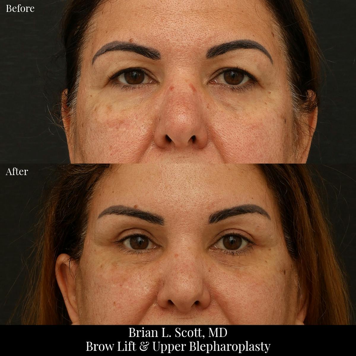 Brow Lift Before & After Gallery - Patient 330643 - Image 1