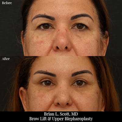 Brow Lift Before & After Gallery - Patient 330643 - Image 1
