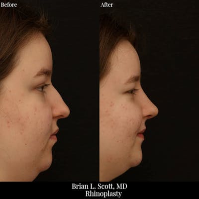 Rhinoplasty Before & After Gallery - Patient 384916 - Image 1
