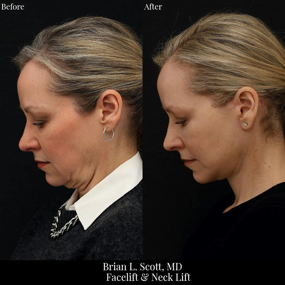 Facelift Before & After Gallery - Patient 378813 - Image 3
