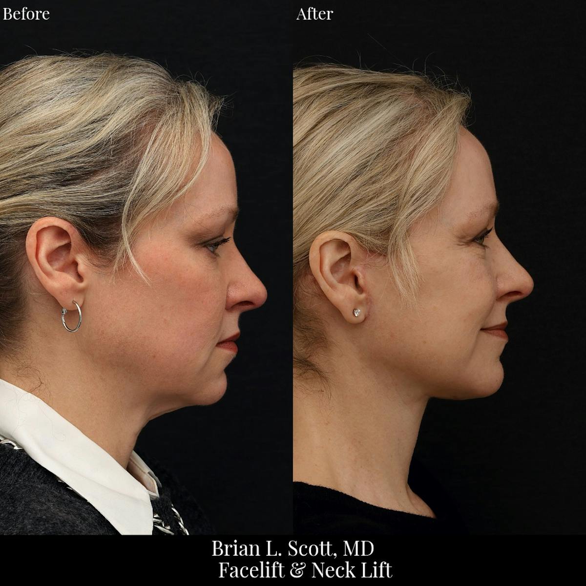 Facelift Before & After Gallery - Patient 378813 - Image 1