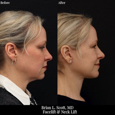Neck Lift Before & After Gallery - Patient 404886 - Image 1