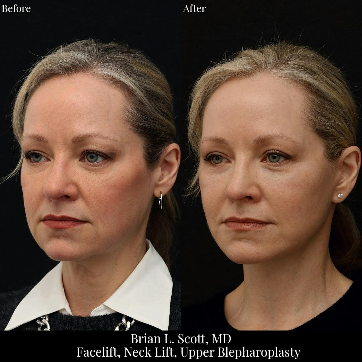 Facelift Before & After Gallery - Patient 378813 - Image 2