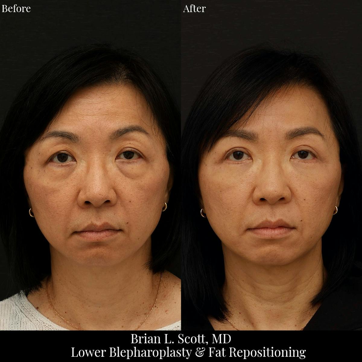 Lower Blepharoplasty Before & After Gallery - Patient 424911 - Image 1