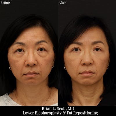 Lower Blepharoplasty Before & After Gallery - Patient 424911 - Image 1