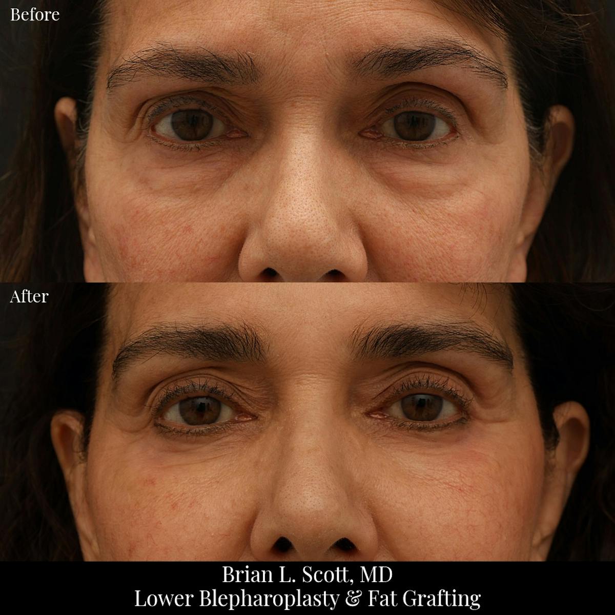 Lower Blepharoplasty Before & After Gallery - Patient 411158 - Image 1