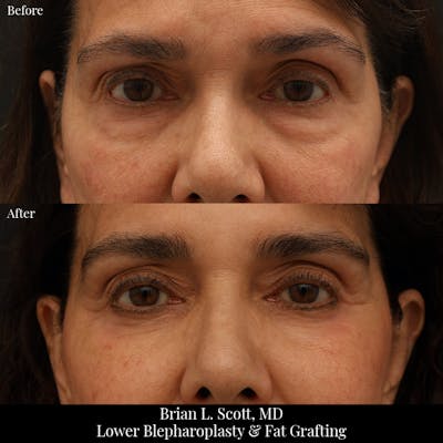 Facial Fat Transfer Before & After Gallery - Patient 306110 - Image 1