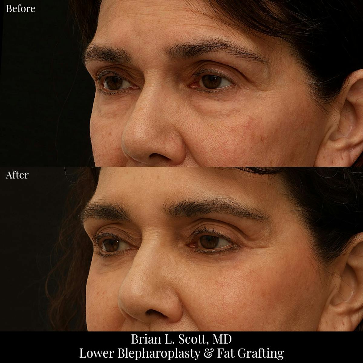Lower Blepharoplasty Before & After Gallery - Patient 411158 - Image 3