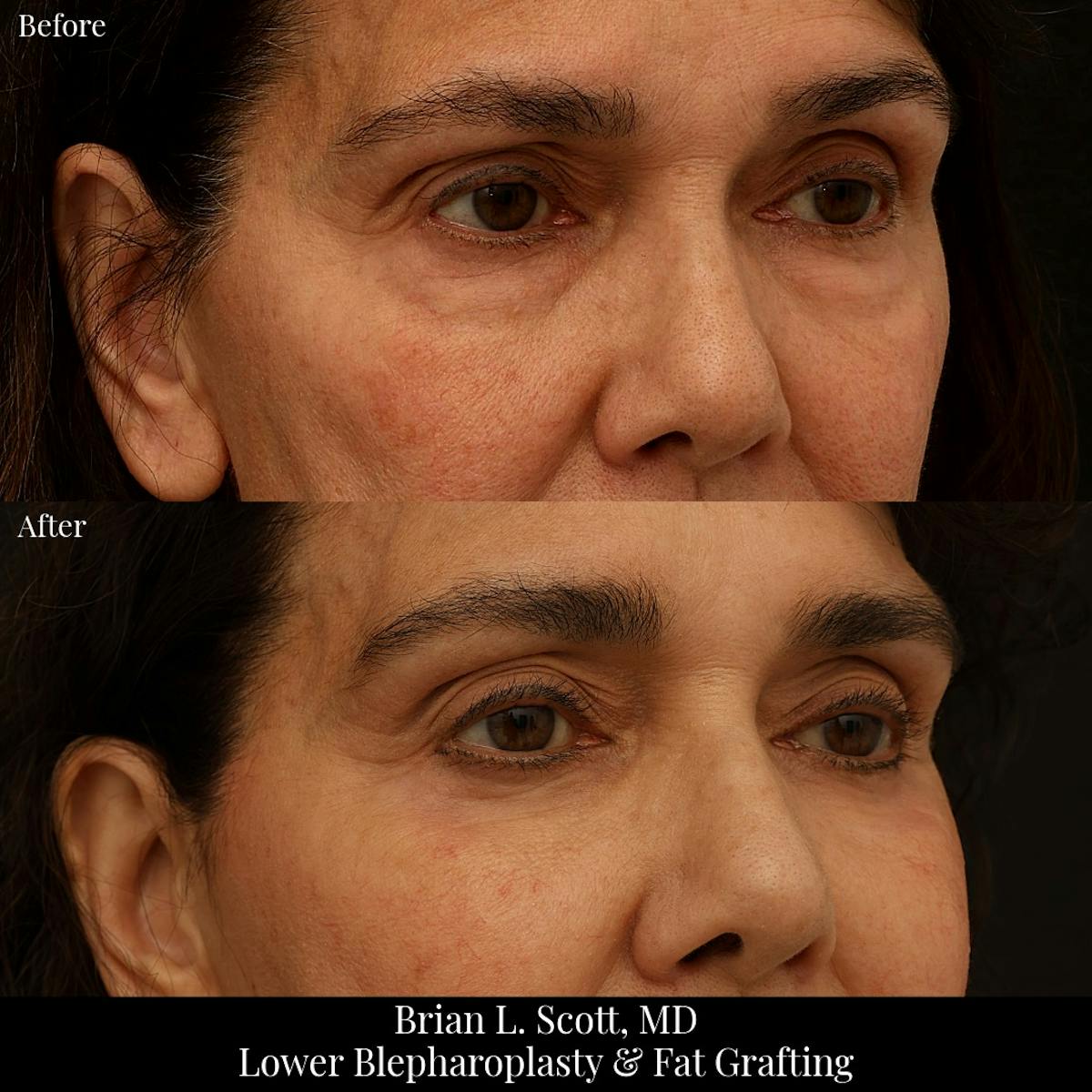Lower Blepharoplasty Before & After Gallery - Patient 411158 - Image 2