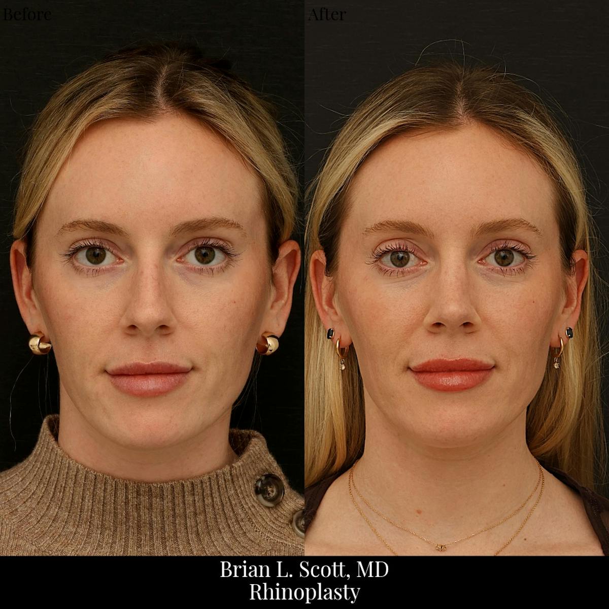 Rhinoplasty Before & After Gallery - Patient 134332 - Image 2