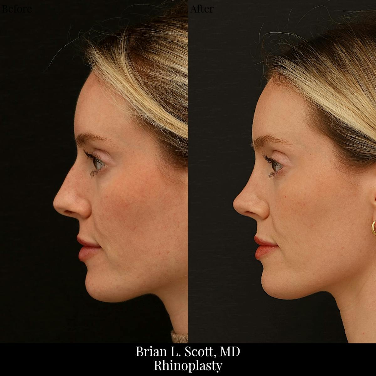 Rhinoplasty Before & After Gallery - Patient 134332 - Image 3