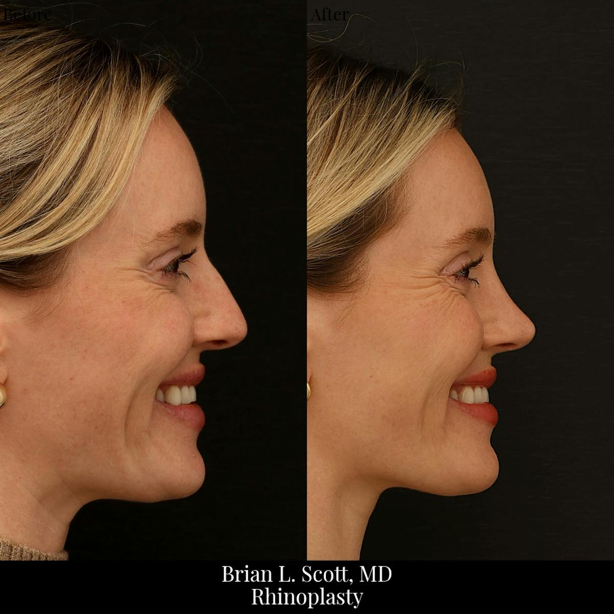 Rhinoplasty Before & After Gallery - Patient 134332 - Image 1