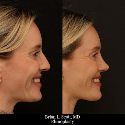 Rhinoplasty Before & After Gallery - Patient 134332 - Image 1