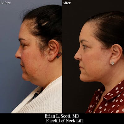 Facelift Before & After Gallery - Patient 728286 - Image 1