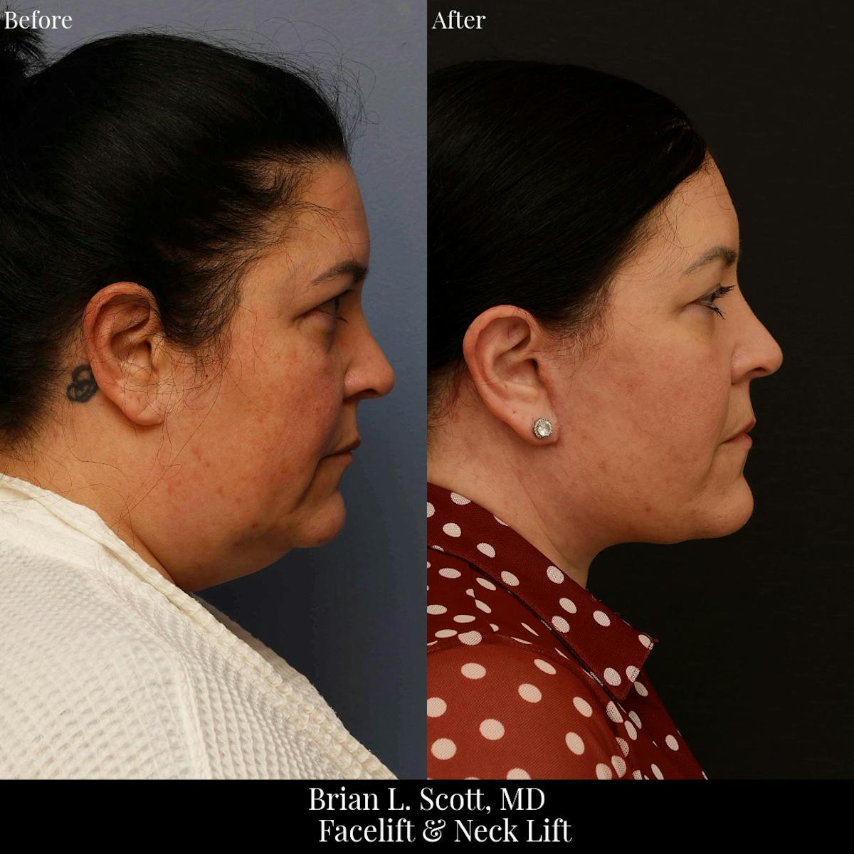 Facelift Before & After Gallery - Patient 728286 - Image 2