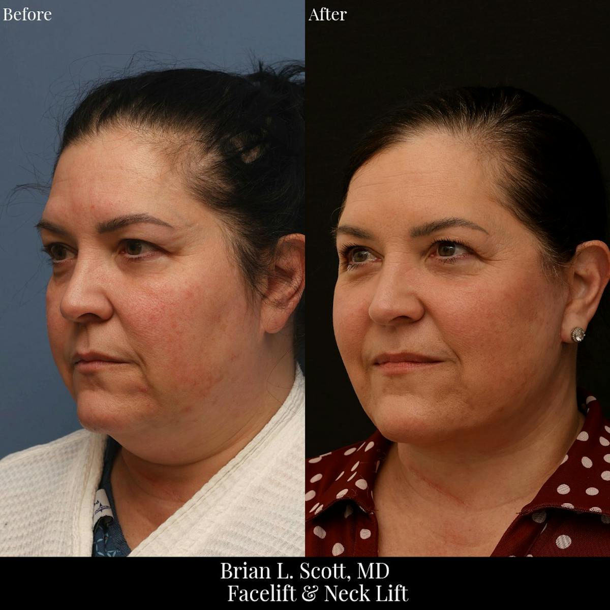 Facelift Before & After Gallery - Patient 728286 - Image 3