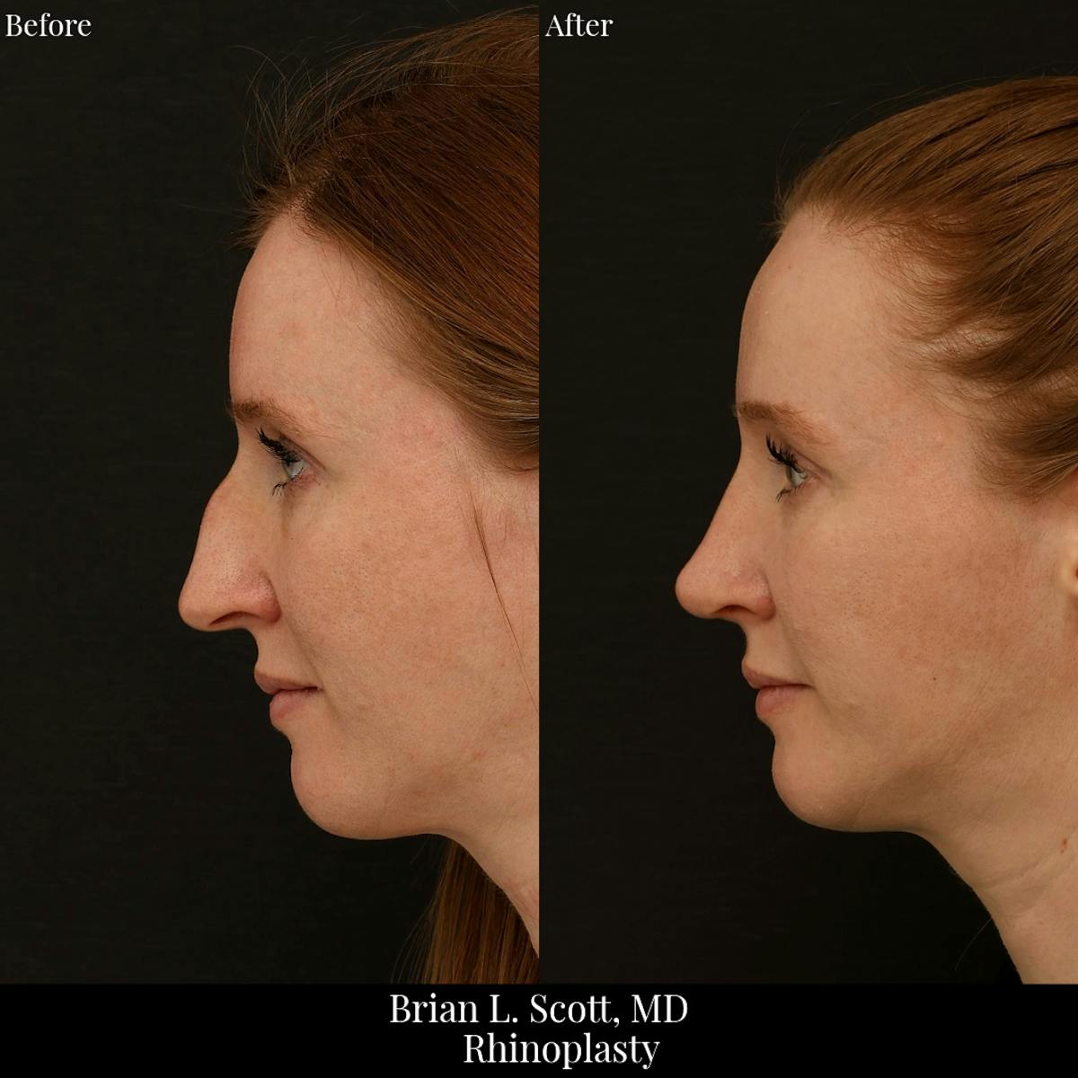 Rhinoplasty Before & After Gallery - Patient 134856 - Image 3