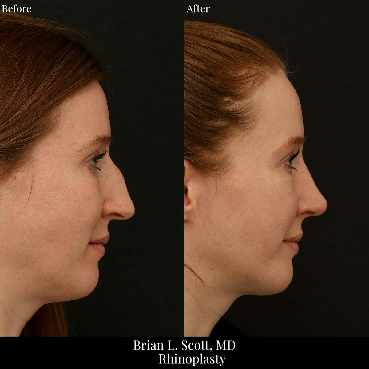 Rhinoplasty Before & After Gallery - Patient 134856 - Image 1