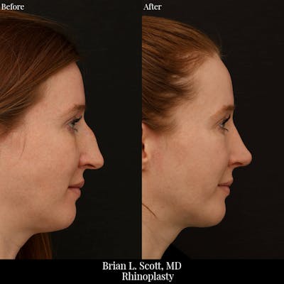Rhinoplasty Before & After Gallery - Patient 134856 - Image 1