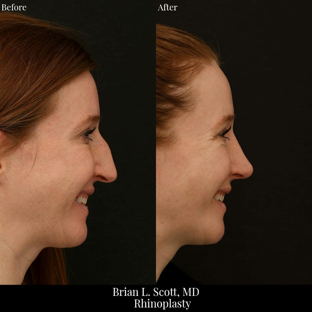Rhinoplasty Before & After Gallery - Patient 134856 - Image 2