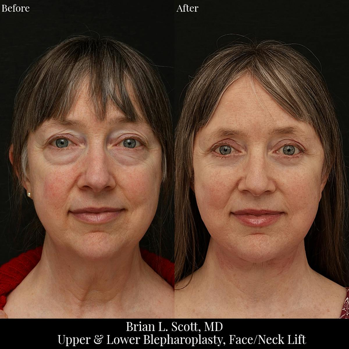 Lower Blepharoplasty Before & After Gallery - Patient 703184 - Image 2