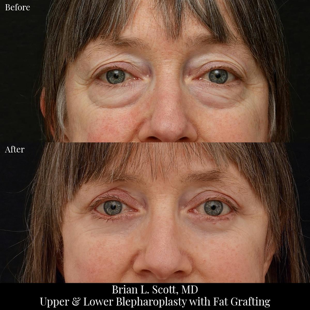 Lower Blepharoplasty Before & After Gallery - Patient 703184 - Image 1
