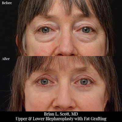 Upper Blepharoplasty Before & After Gallery - Patient 345372 - Image 1