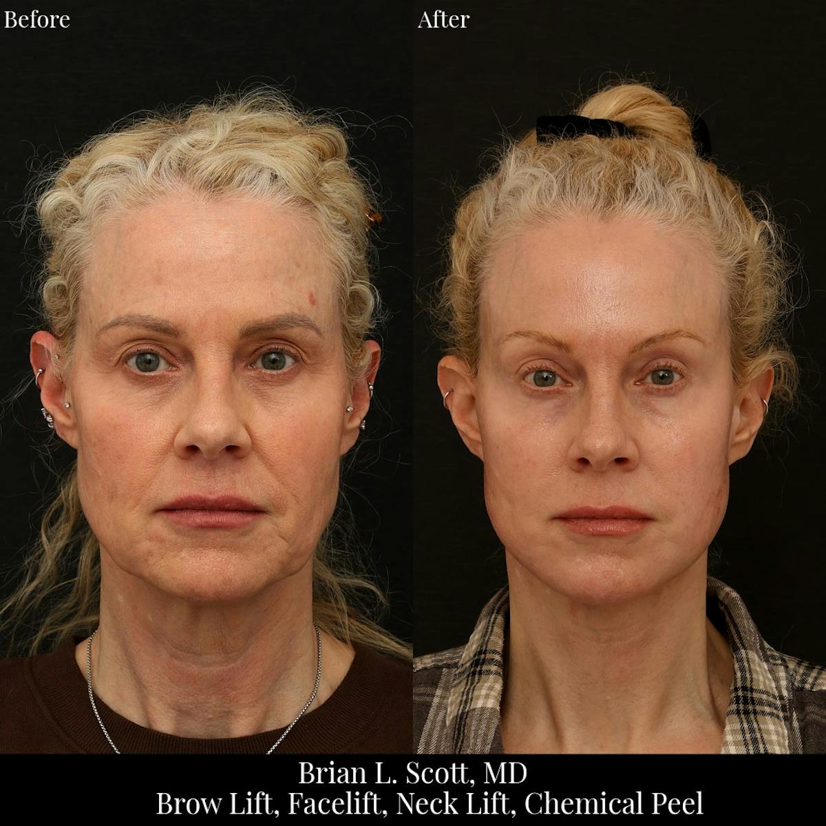Facelift Before & After Gallery - Patient 331713 - Image 1