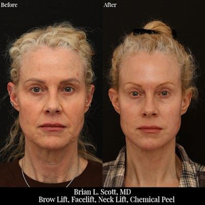 Brow Lift Before & After Gallery - Patient 425801 - Image 1