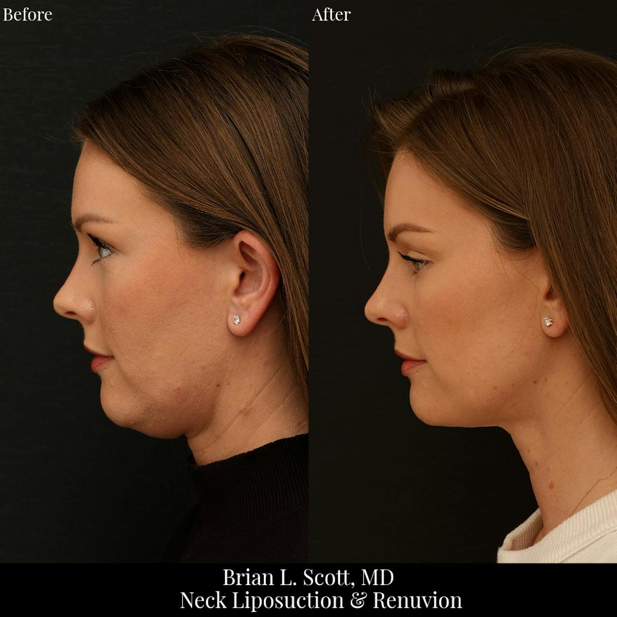 Neck Liposuction Before & After Gallery - Patient 213988 - Image 1