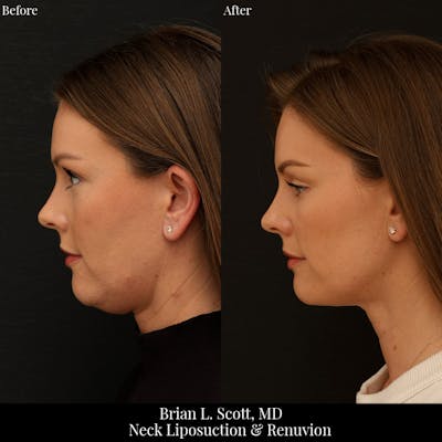 Neck Liposuction Before & After Gallery - Patient 213988 - Image 1