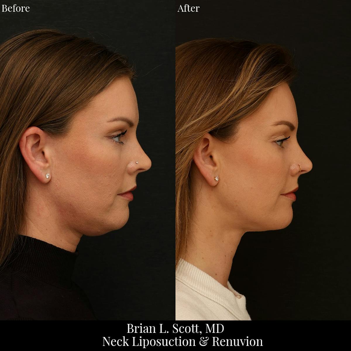 Neck Liposuction Before & After Gallery - Patient 213988 - Image 2