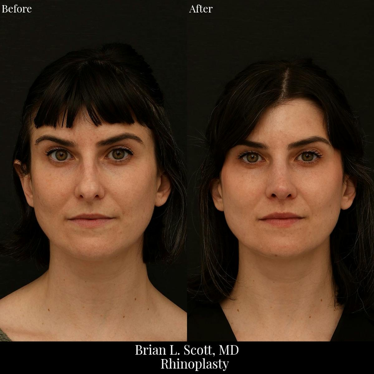 Rhinoplasty Before & After Gallery - Patient 271959 - Image 2