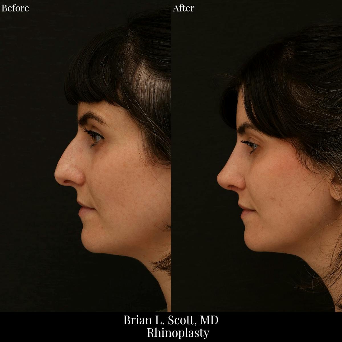 Rhinoplasty Before & After Gallery - Patient 271959 - Image 1