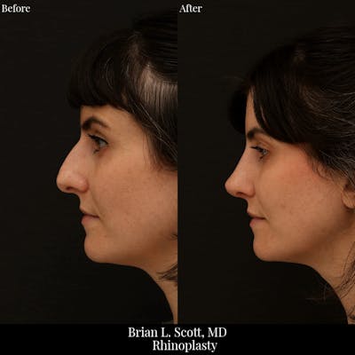 Rhinoplasty Before & After Gallery - Patient 271959 - Image 1
