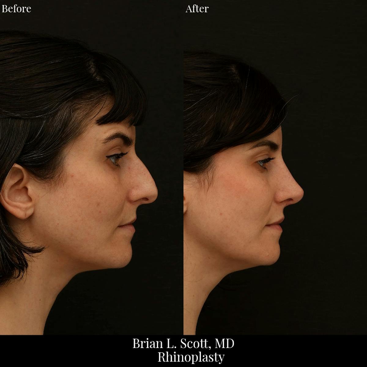 Rhinoplasty Before & After Gallery - Patient 271959 - Image 3