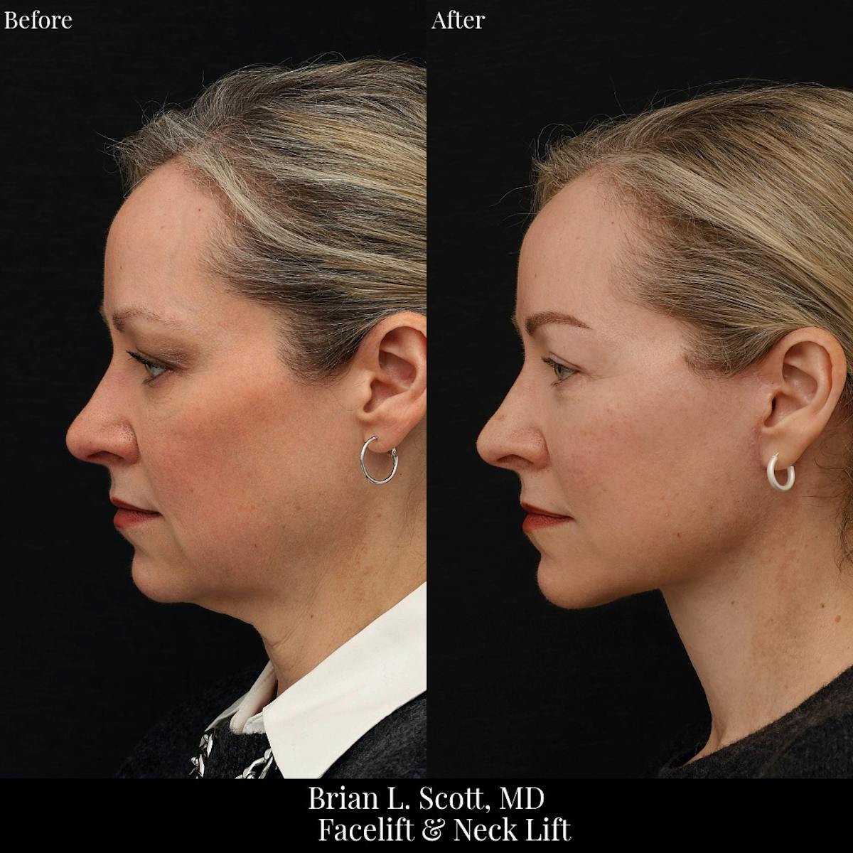 Facelift Before & After Gallery - Patient 378813 - Image 1