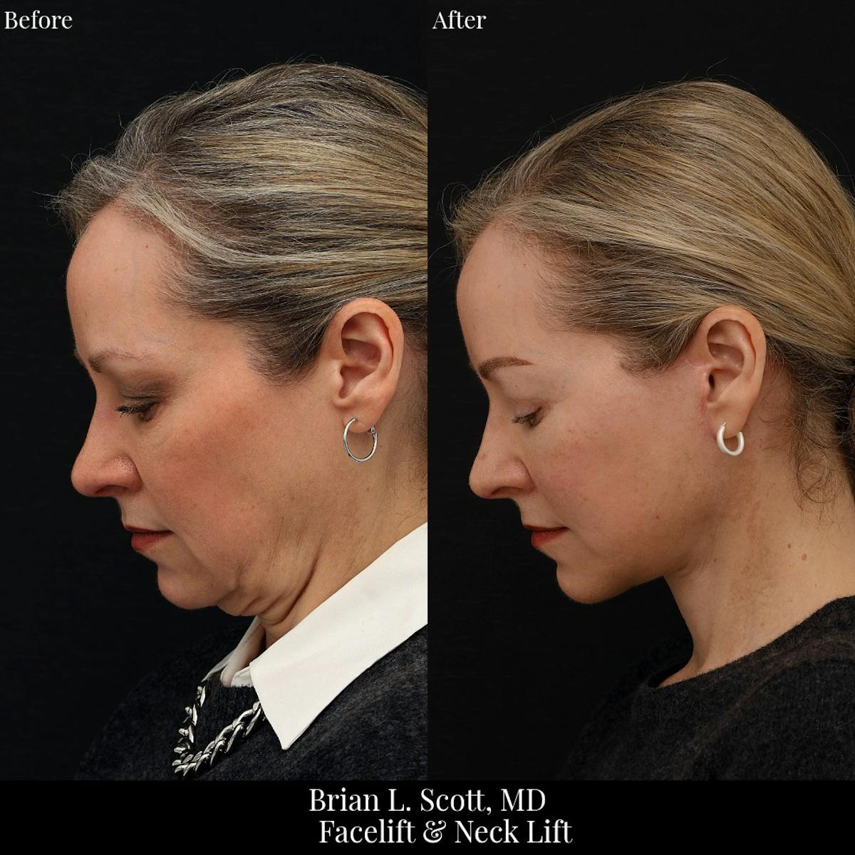 Facelift Before & After Gallery - Patient 378813 - Image 2