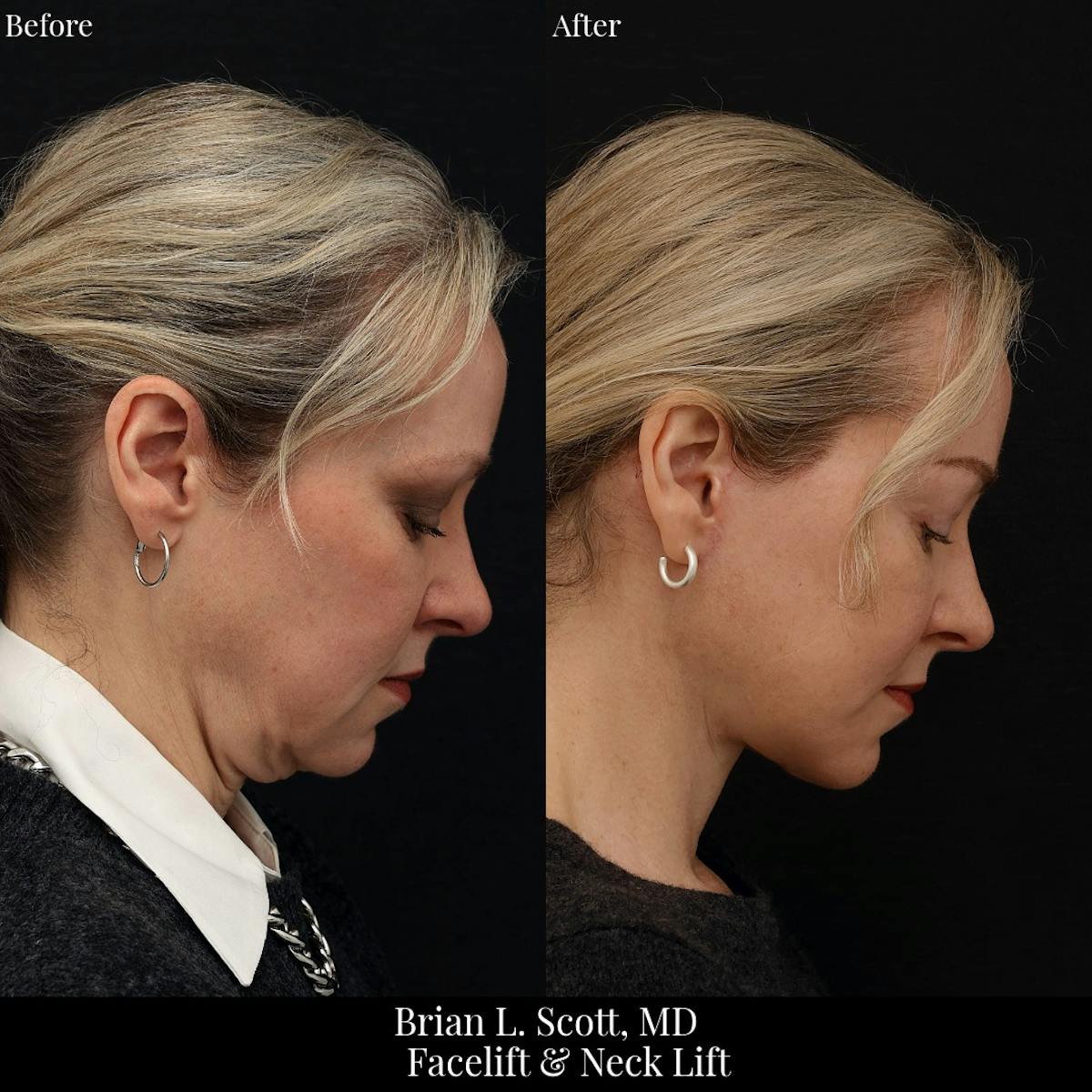 Facelift Before & After Gallery - Patient 378813 - Image 3