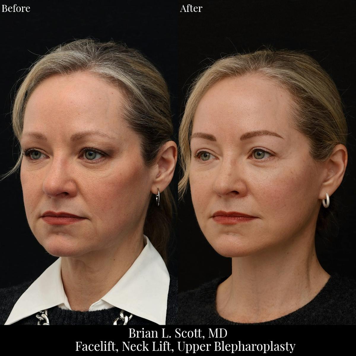 Upper Blepharoplasty Before & After Gallery - Patient 351563 - Image 1