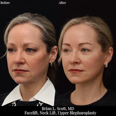 Upper Blepharoplasty Before & After Gallery - Patient 351563 - Image 1