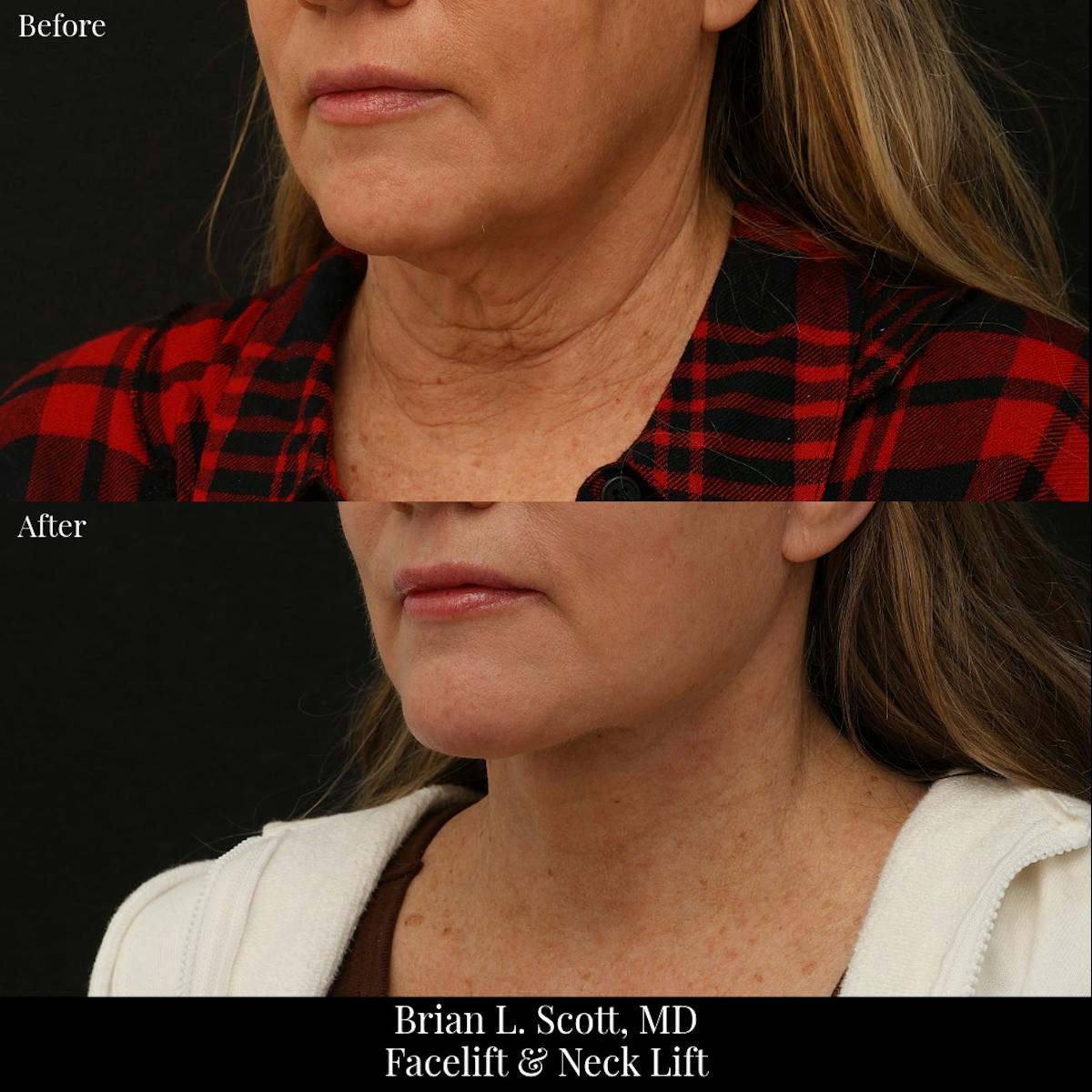 Facelift Before & After Gallery - Patient 336709 - Image 3