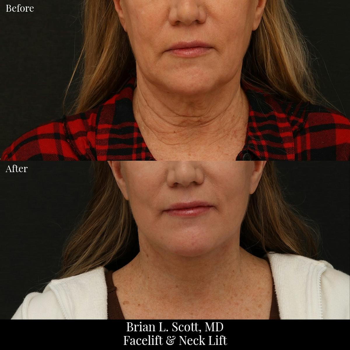 Facelift Before & After Gallery - Patient 336709 - Image 4