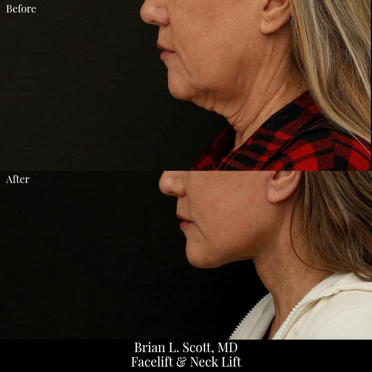 Facelift Before & After Gallery - Patient 336709 - Image 1
