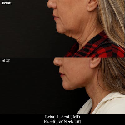 Neck Lift Before & After Gallery - Patient 311216 - Image 1